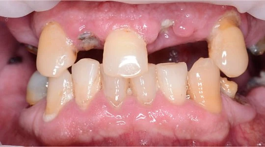 До лечения